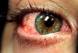 pasadena-dui-symptom-bloodshot-eyes.jpg