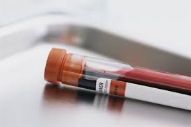 DUI-blood-test-for-los-angeles